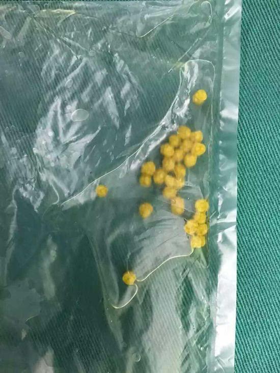 衢州8岁男童胆囊长满26颗结石