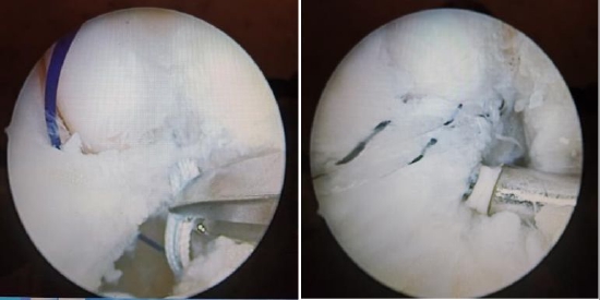 踝关节镜下距腓前韧带铆钉修复加强