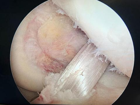 膝关节镜下交叉韧带重建