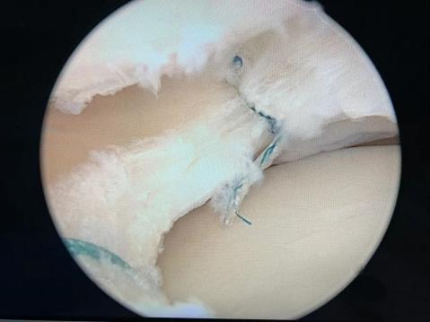 膝关节镜下半月板撕裂缝合