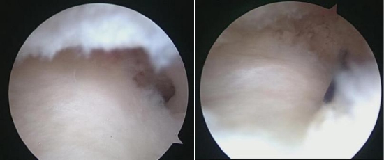 腕关节镜下TFCC损伤修复